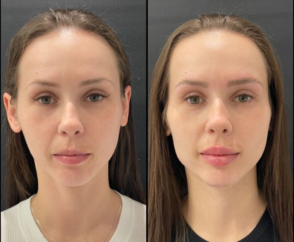 Resultado harmonização facial por Roseli Moreira