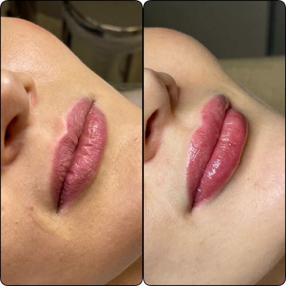 Resultado preenchimento labial por Roseli Moreira