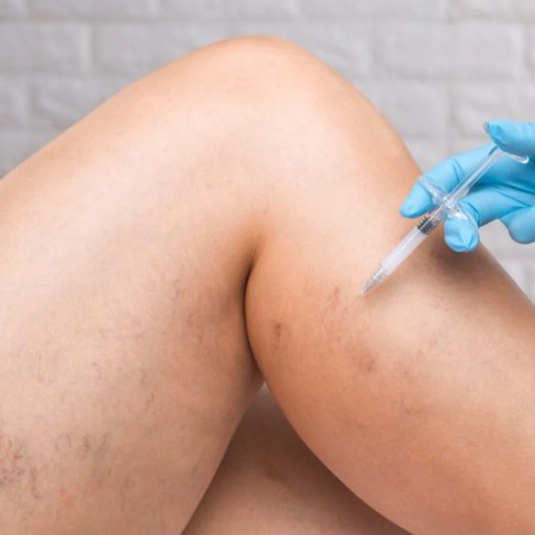 Escleroterapia