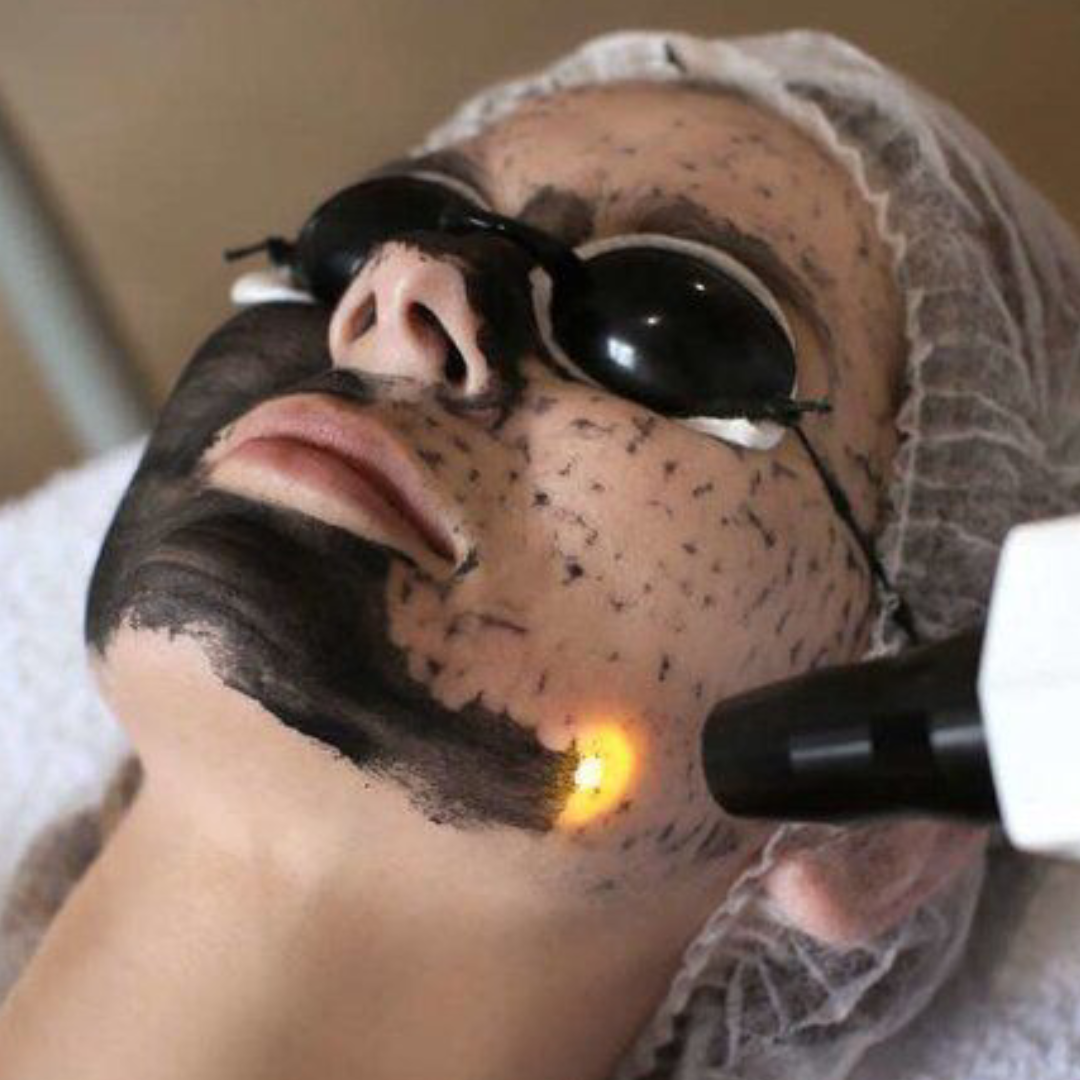 Peeling de Hollywood em Rio do Sul