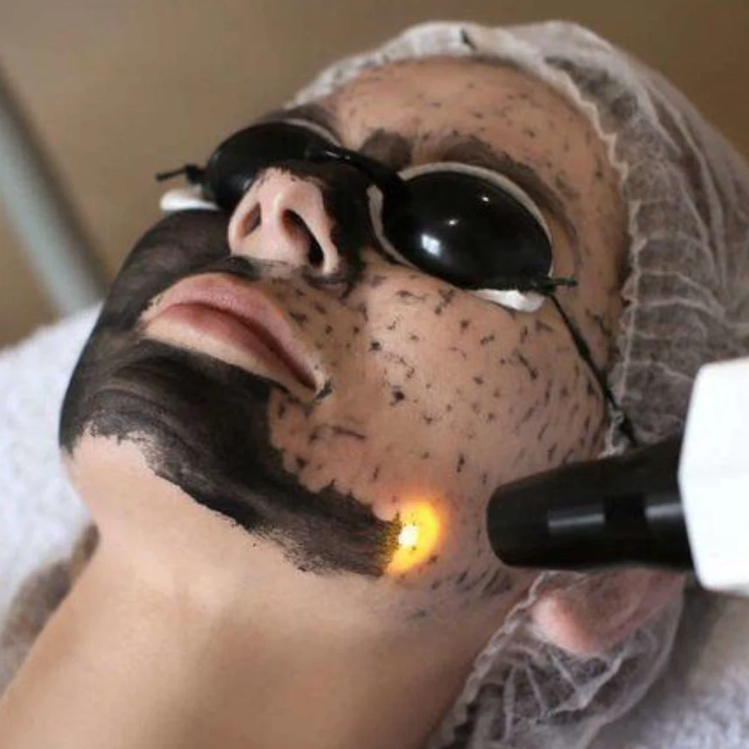Peeling de Hollywood