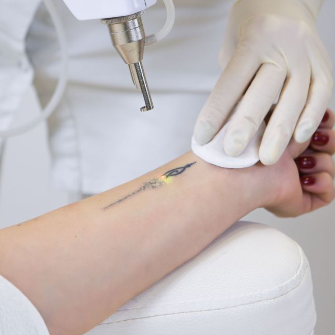 Remoção de Tatuagem