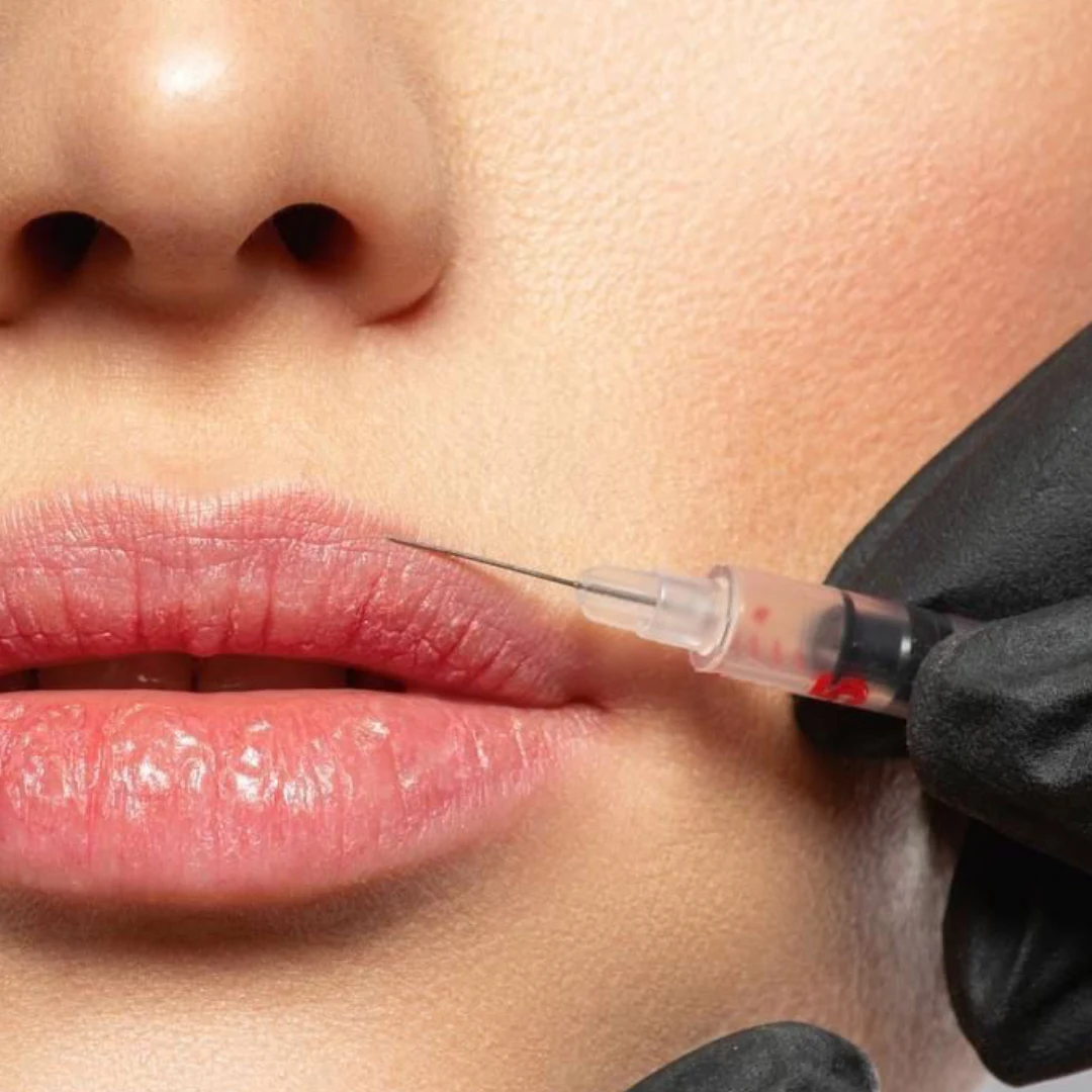 Preenchimento Labial com a Dra. Roseli Moreira
