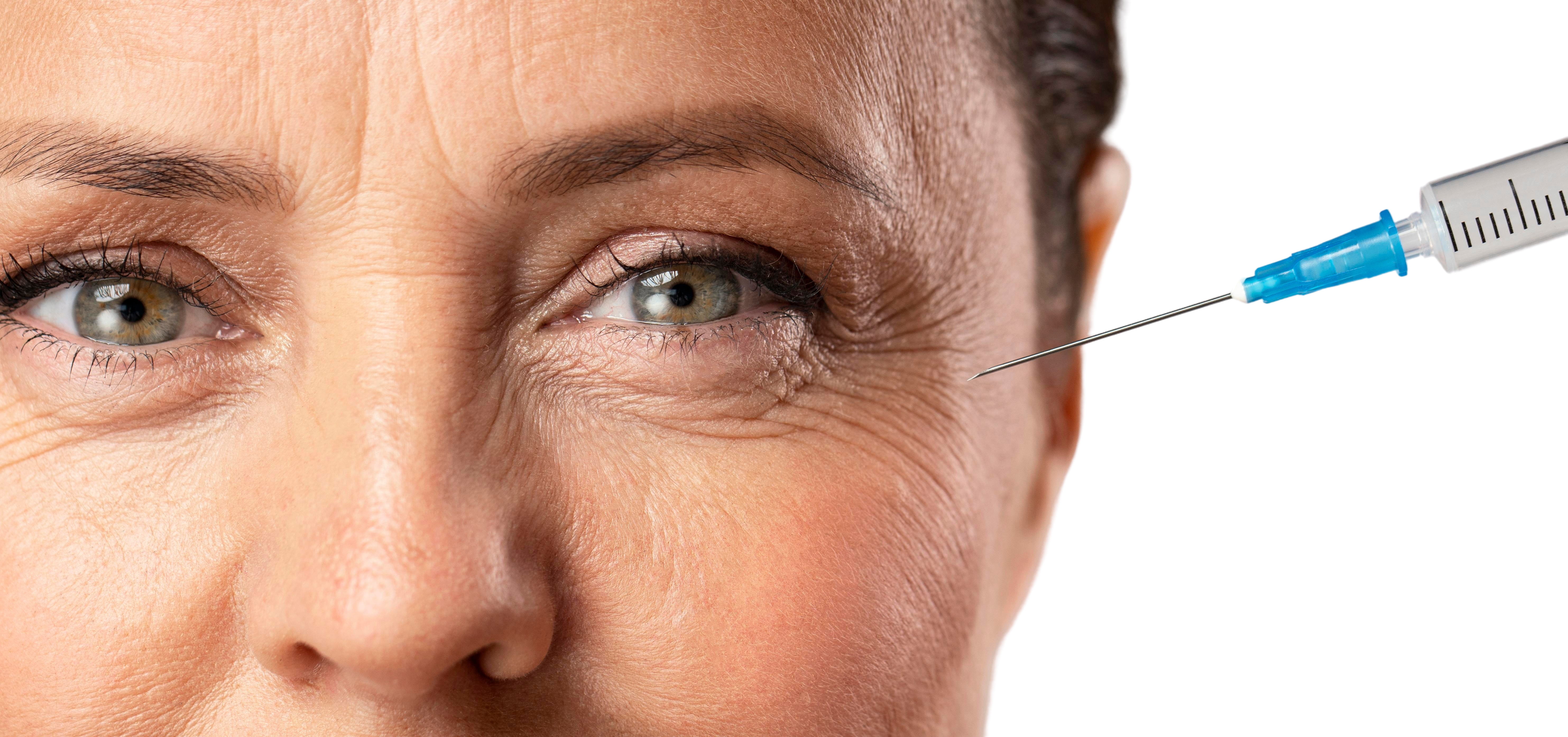 Mulher recebendo Botox em Rio do Sul para suavizar linhas de expressão com resultado natural