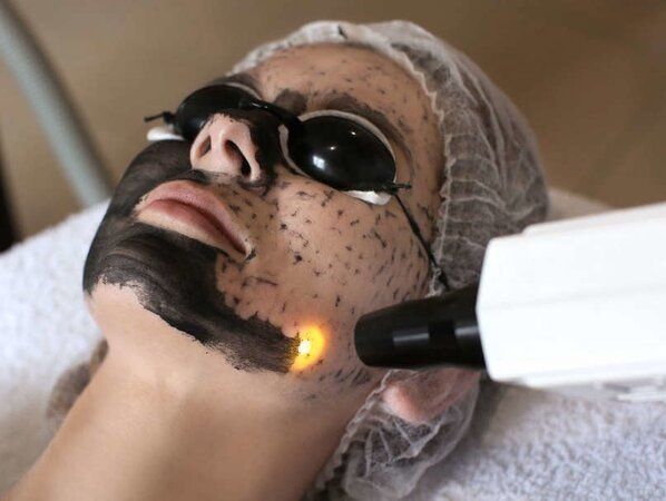 Peeling de Hollywood rio do sul